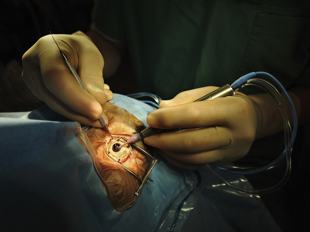 Cataracte : trop d'examens CCE