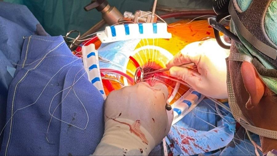 La voie transaxillaire pour toute chirurgie valvulaire du cœur